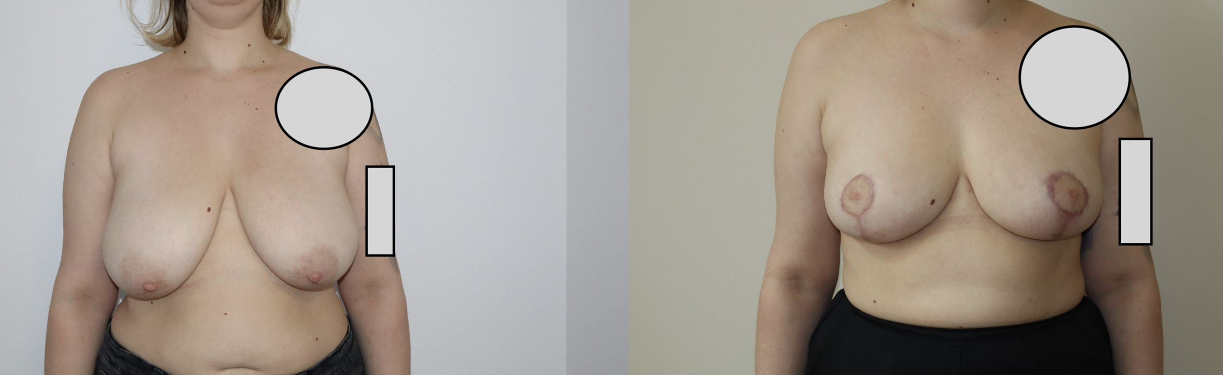 Avant/Après lifting seins et réduction mammaire